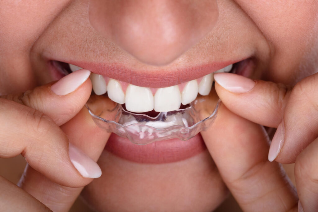 Best Dentist in West Palm Beach Recommends Clear Aligners