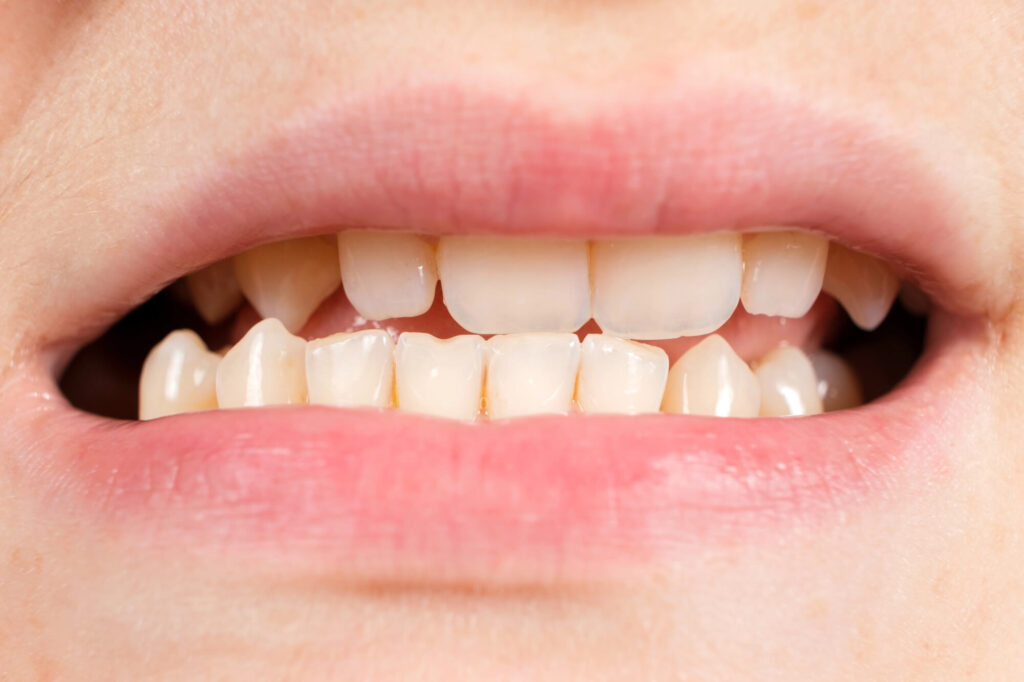 Benefits of Dental Botox