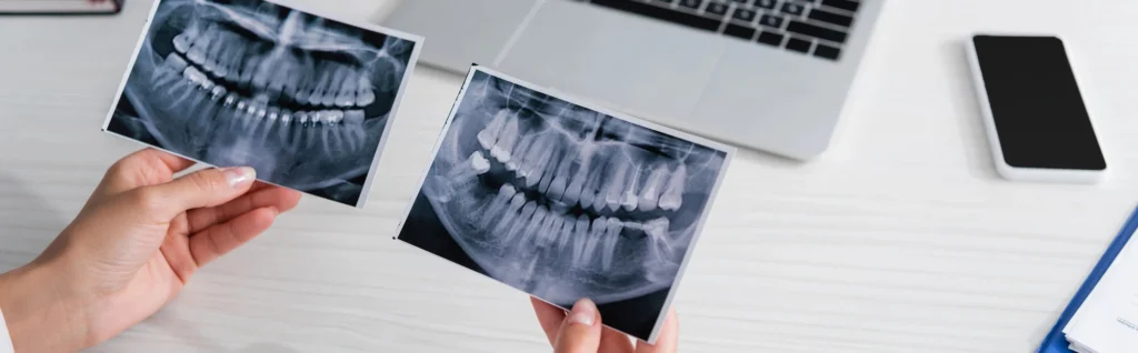 Preparation for Dental Bridges in West Palm Beach